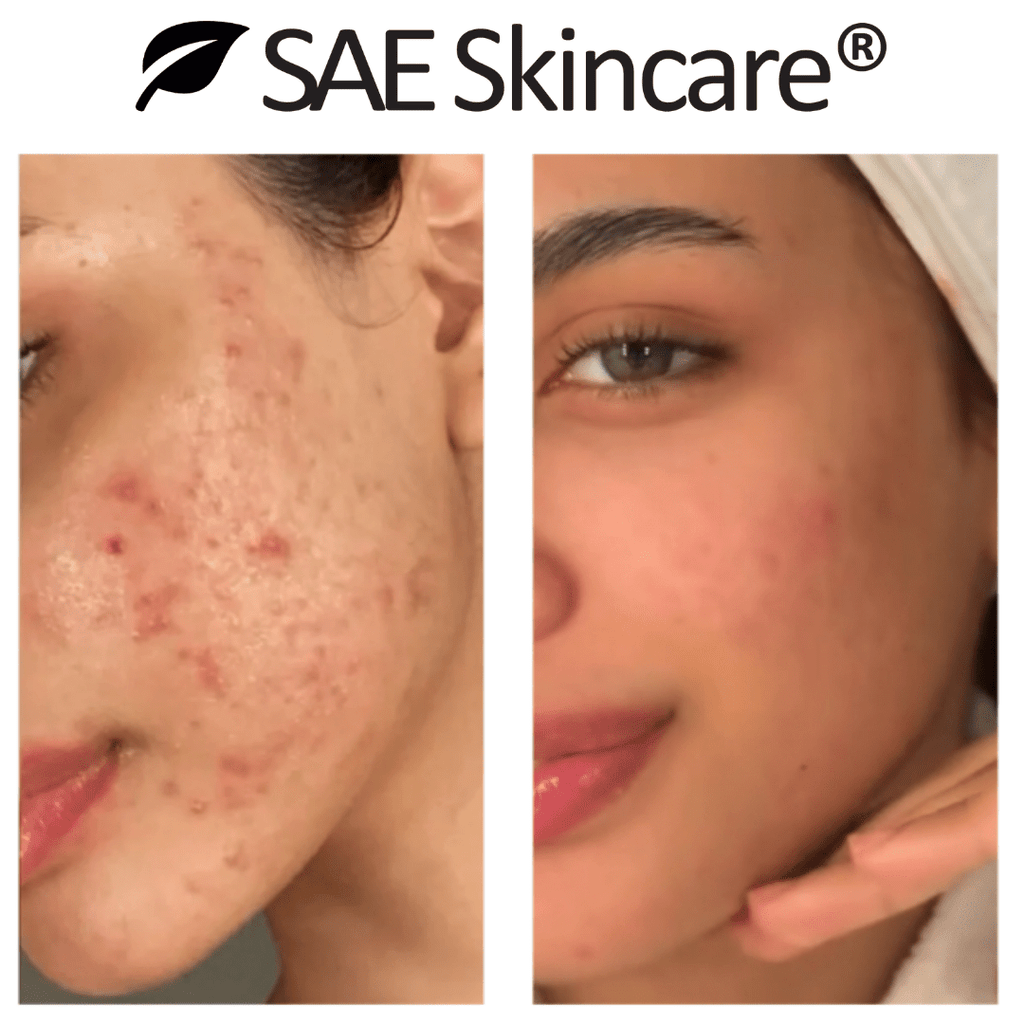 Acne & Oil Control Set - SAE SKINCARE