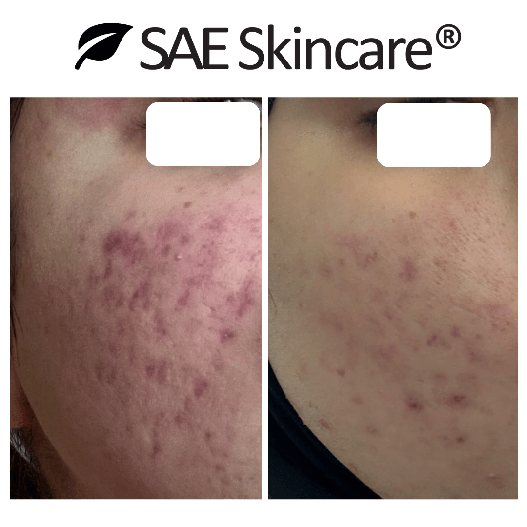Acne & Oil Control Set - SAE SKINCARE