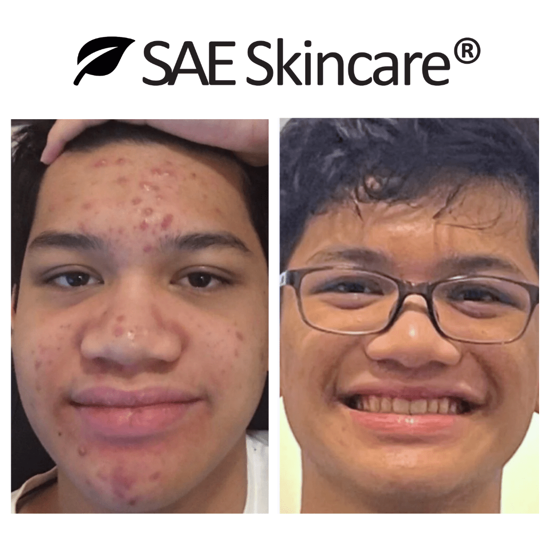 Acne & Oil Control Set - SAE SKINCARE