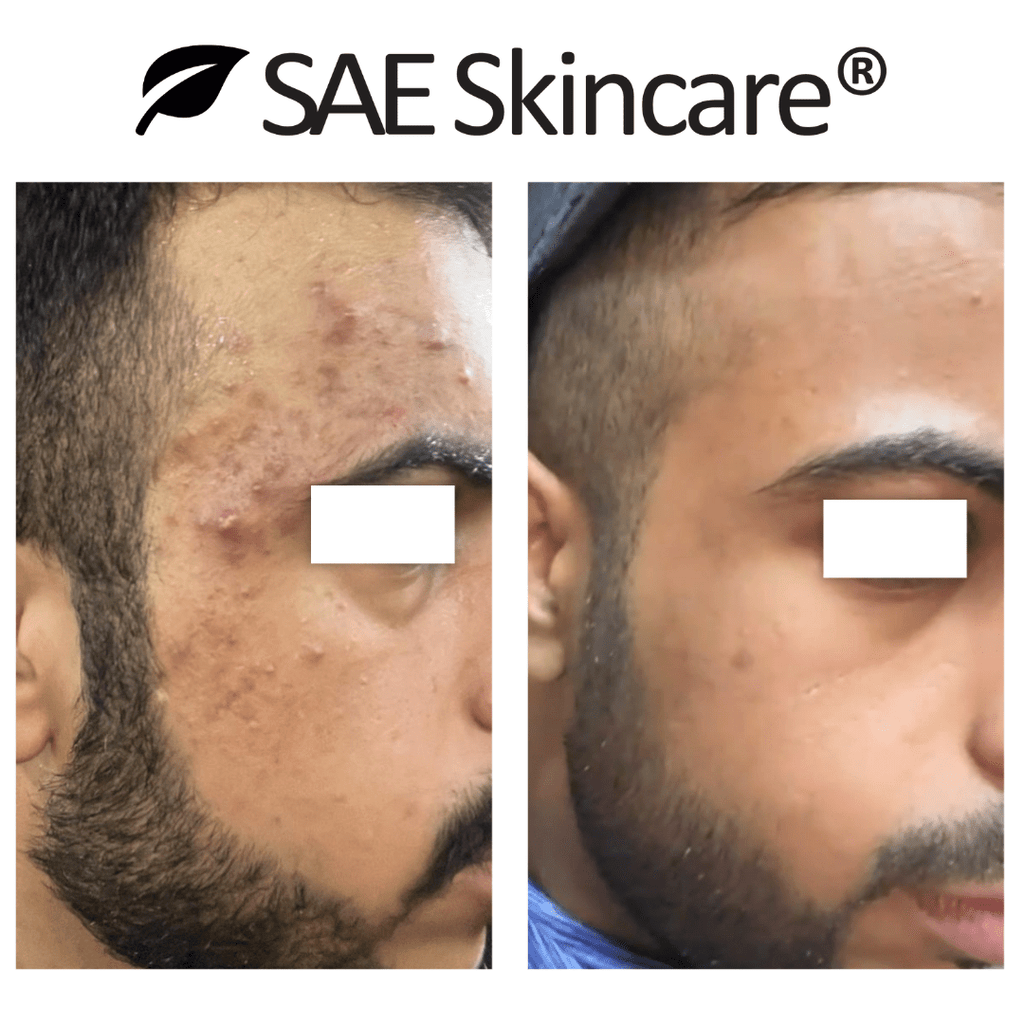 Acne & Oil Control Set - SAE SKINCARE