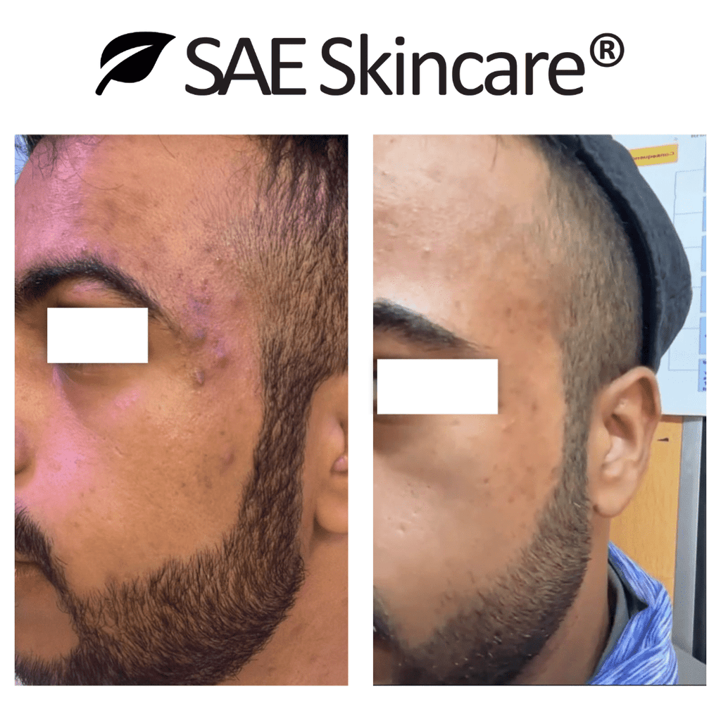 Acne & Oil Control Set - SAE SKINCARE