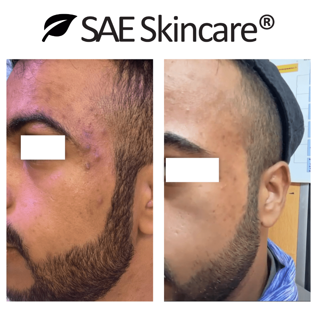 Acne & Oil Control Set - SAE SKINCARE