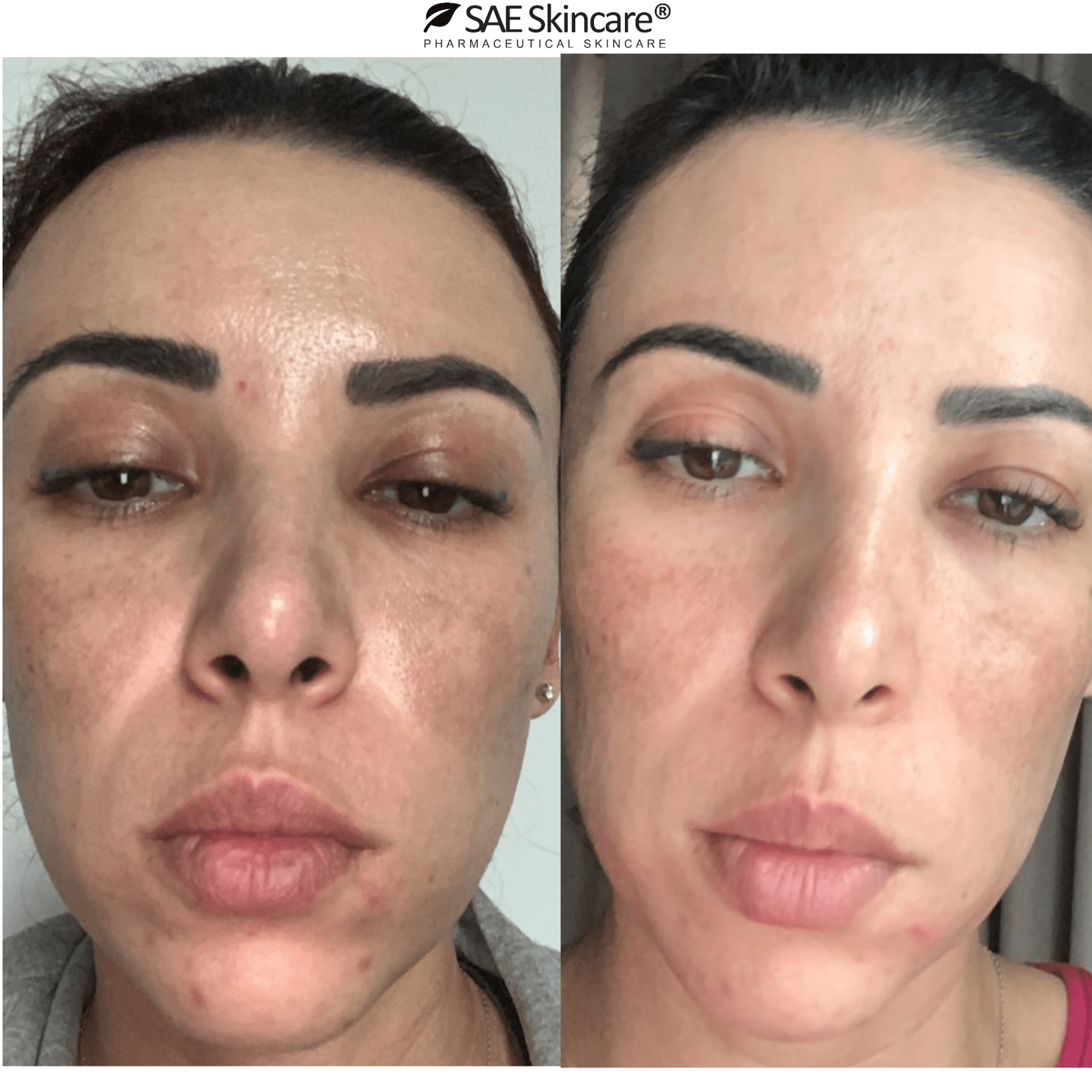 Brightening and Pigmentation Set - SAE SKINCARE