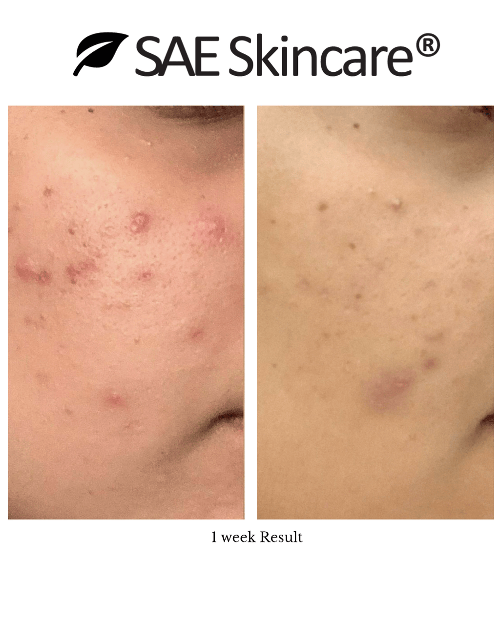 Pore Control Kit - SAE SKINCARE