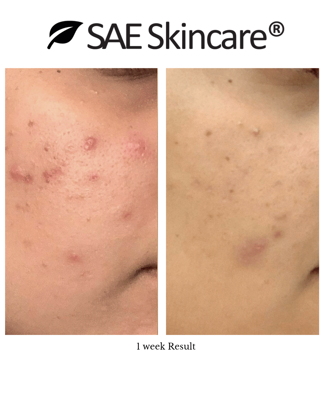 Pore Control Kit - SAE SKINCARE